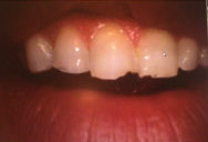 Grinding teeth Bellevue WA